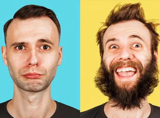 beard transplant
