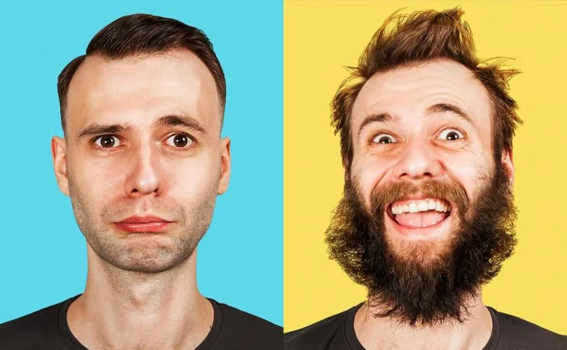 beard transplant