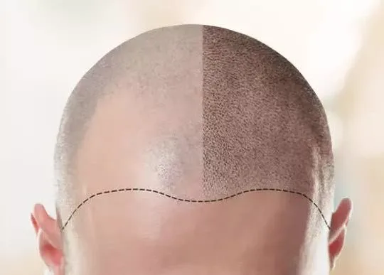 Process of Hair Transplantation