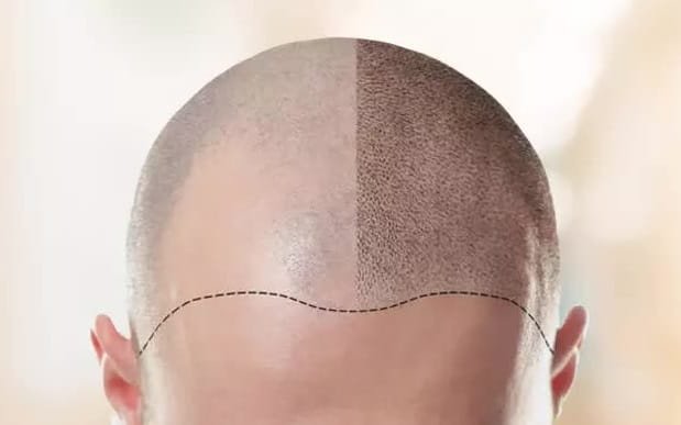 Process of Hair Transplantation