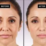 Wrinkles are gone!